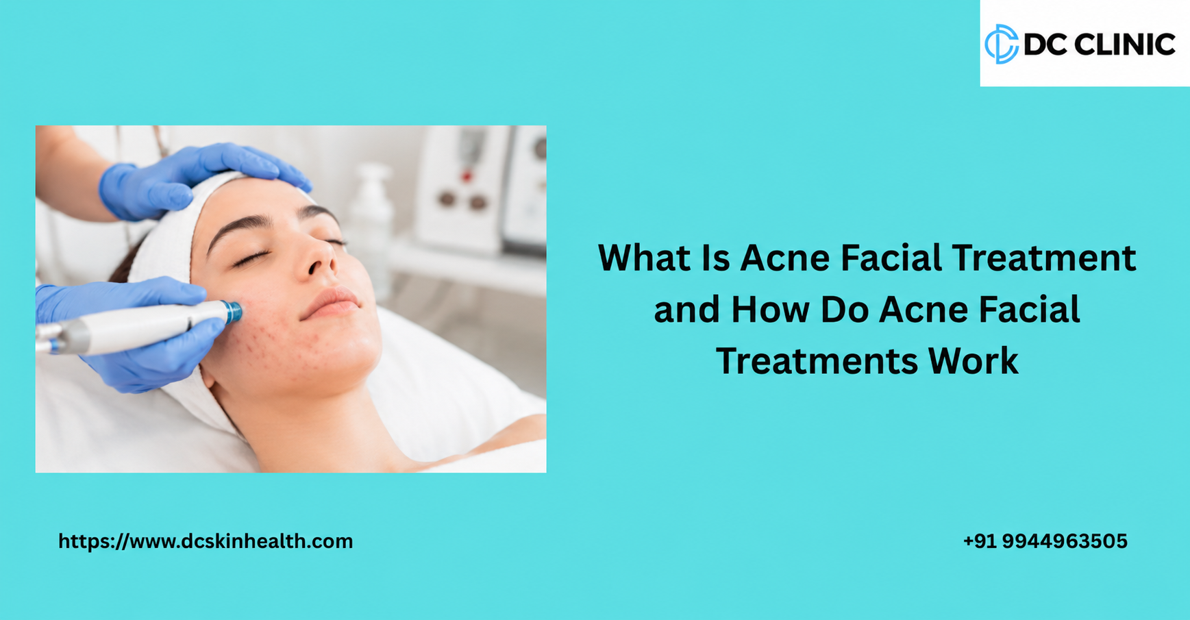 why-do-i-keep-getting-acne-common-causes-and-what-you-can-do